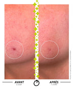Garancia Sérum L'ELIXIR DU MARABOUT : Comparatif avant/après en 7 jours montrant l'efficacité d'un soin Garancia sur une imperfection cutanée ciblée. La peau est visiblement plus nette et le relief cutané lissé.